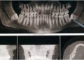 how jawbone loss impacts facial structure