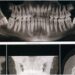 how jawbone loss impacts facial structure