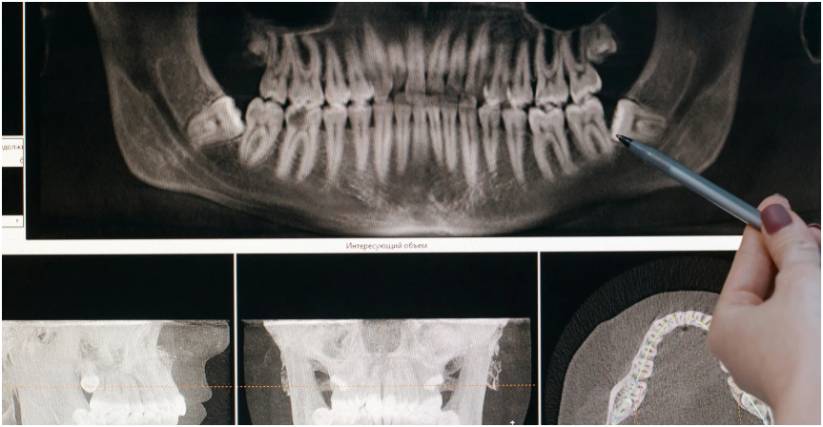 how jawbone loss impacts facial structure